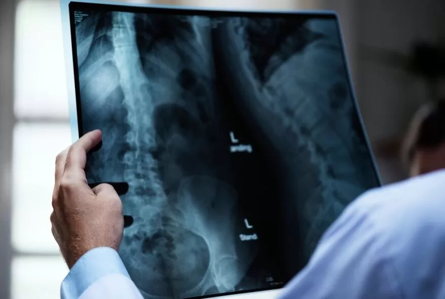 Osteoporosis afecta una de cada tres mujeres y uno de cada cinco hombres mayores de 50 años en México: INR
